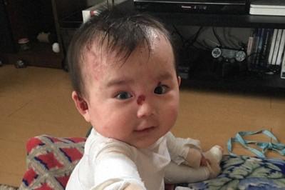 希少難病・表皮水疱症、国内に約1000人　患者団体「現実知って」